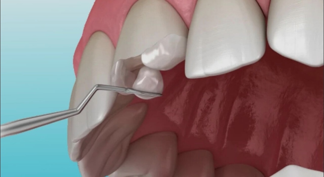 Dental Filling