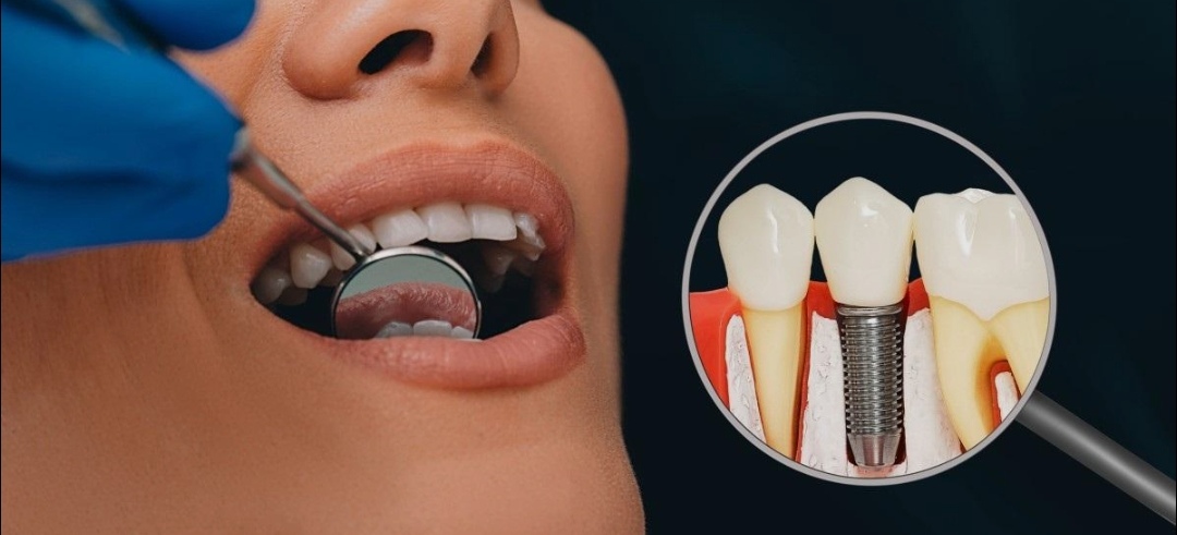 Dental Implant